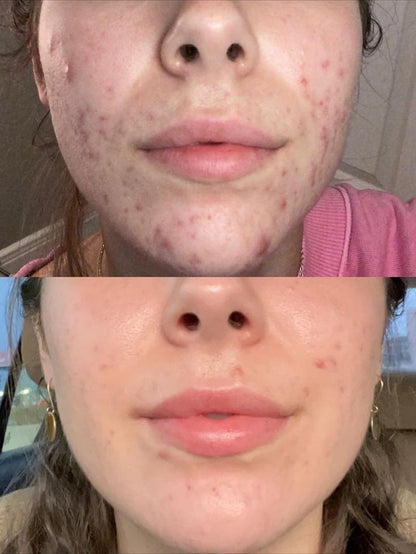 Calma Labs Dérmica™ | Sistema de Microinfusión Facial