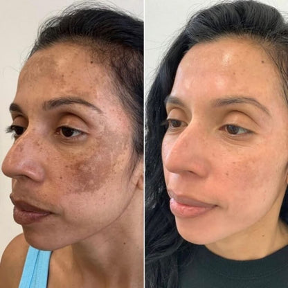 Calma Labs Dérmica™ | Sistema de Microinfusión Facial