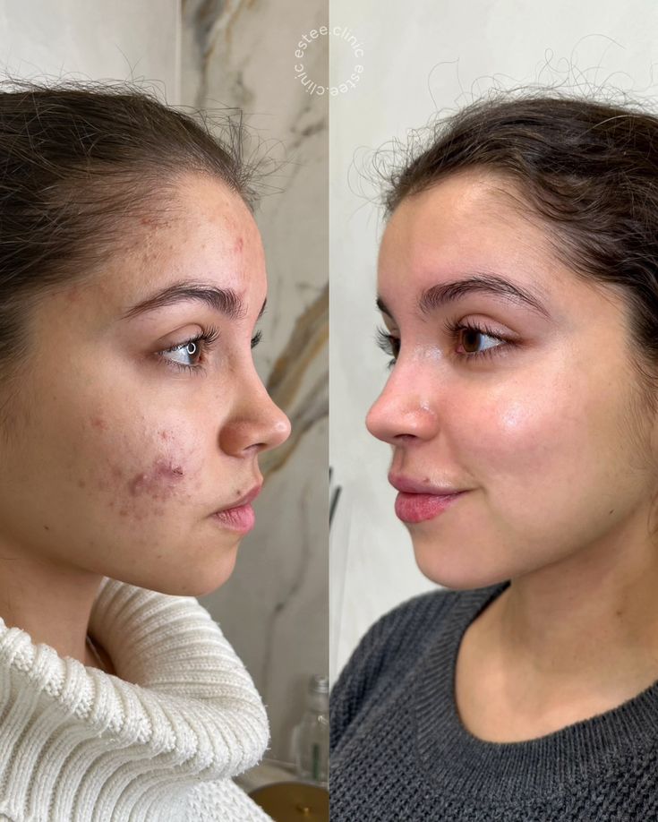 Calma Labs Dérmica™ | Sistema de Microinfusión Facial